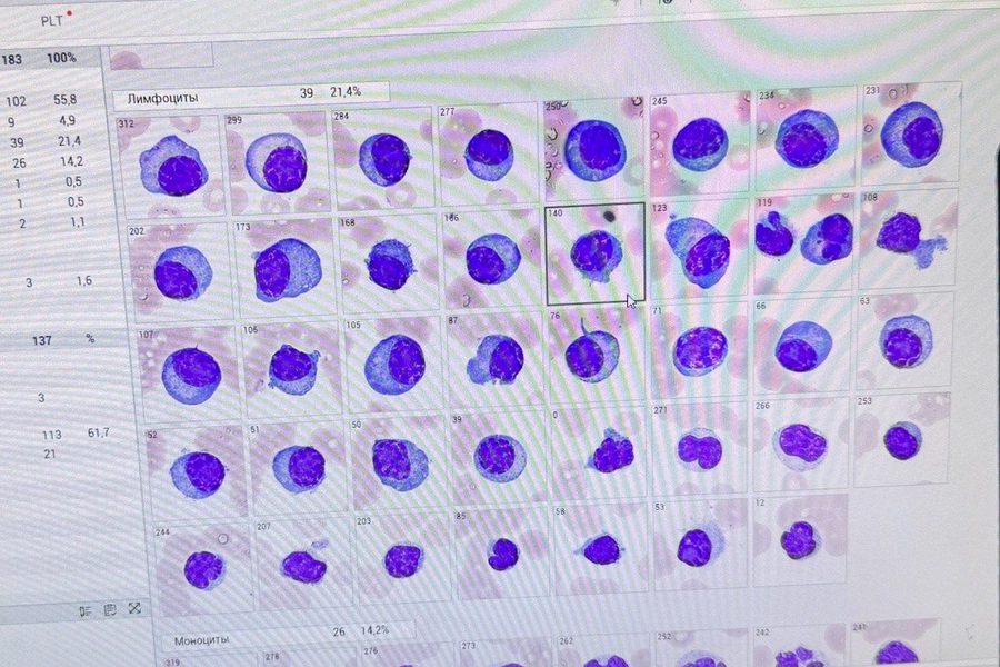 Rouleaux Formation and Plasma Cells in Peripheral Blood Smear