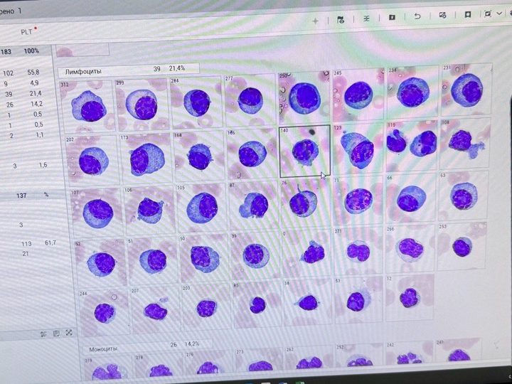 Digital microscope screen with a gallery of atypical mononuclear cells and plasma cells