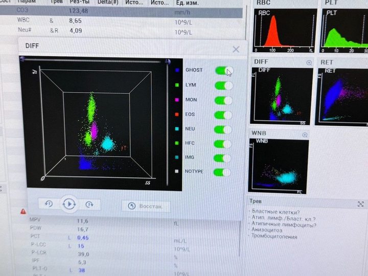 Hematology analyzer screen with scattergrams and ESR 123.5 mm/h