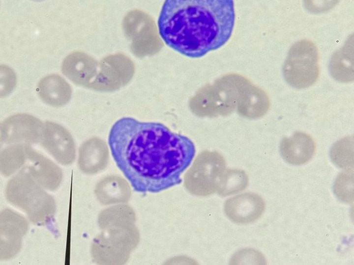 Blood smear: plasma cells with basophilic cytoplasm and rouleaux formation