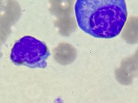 Blood smear: plasma cell with eccentric nucleus and lymphocyte