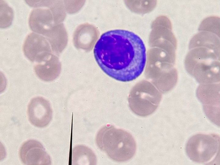 Blood smear: plasma cell with perinuclear halo against a background of aggregation