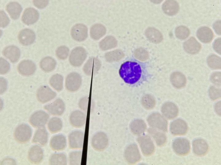 Blood smear: atypical lymphoid element with cytoplasmic projections