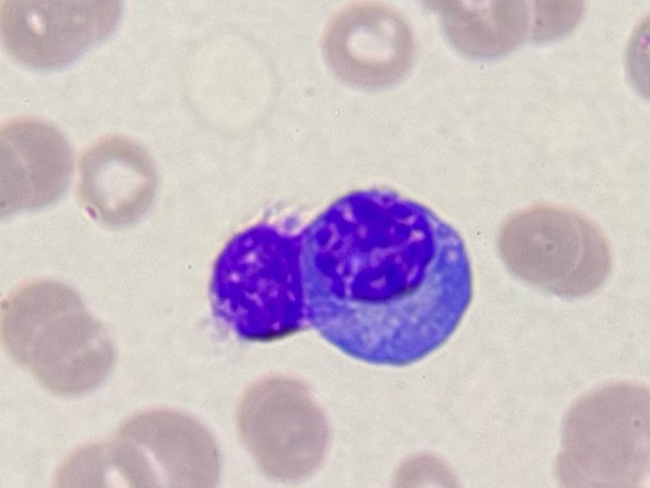 Blood smear: binucleated plasma cell against a background of red blood cell rouleaux