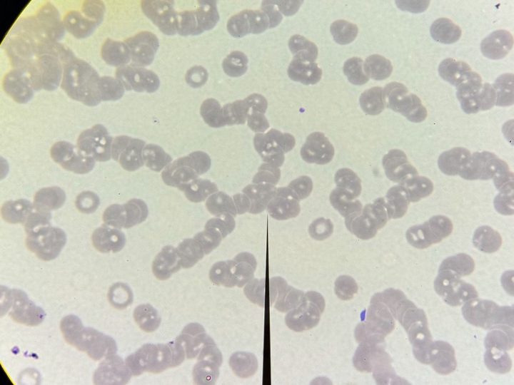 Blood smear at low power: pronounced red blood cell rouleaux formation