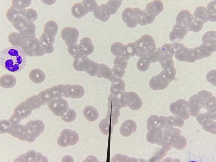 Blood smear: segmented neutrophil, plasma cell, and red blood cell agglutination