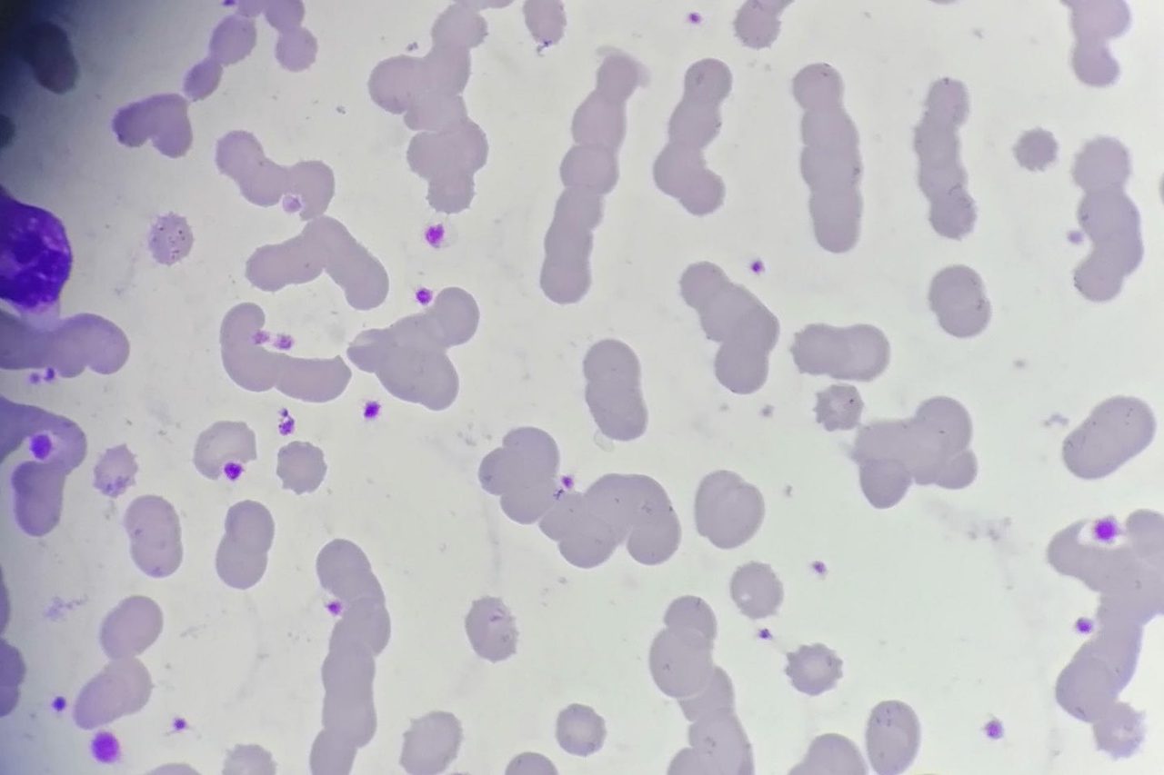 Rouleaux Formation in Multiple Myeloma: A Blood Smear Case