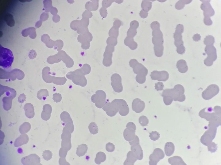 Blood smear: typical erythrocyte rouleaux formation in multiple myeloma