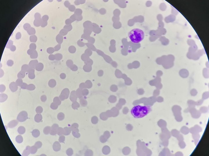 Blood smear: erythrocyte aggregation into chains and segmented neutrophils