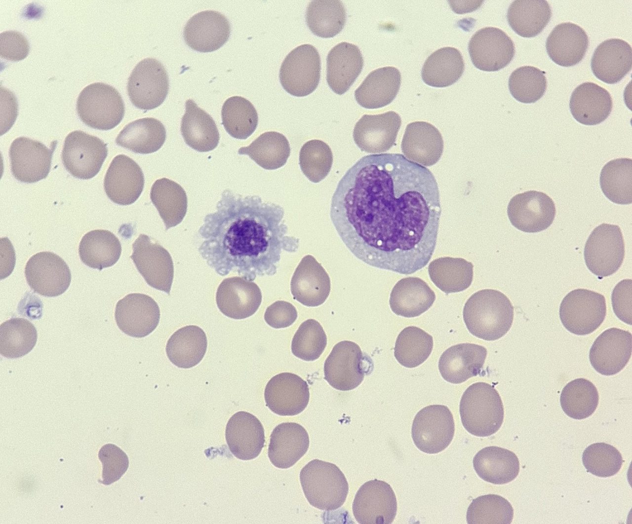 Blood smear: monocyte with kidney-shaped nucleus and giant platelet