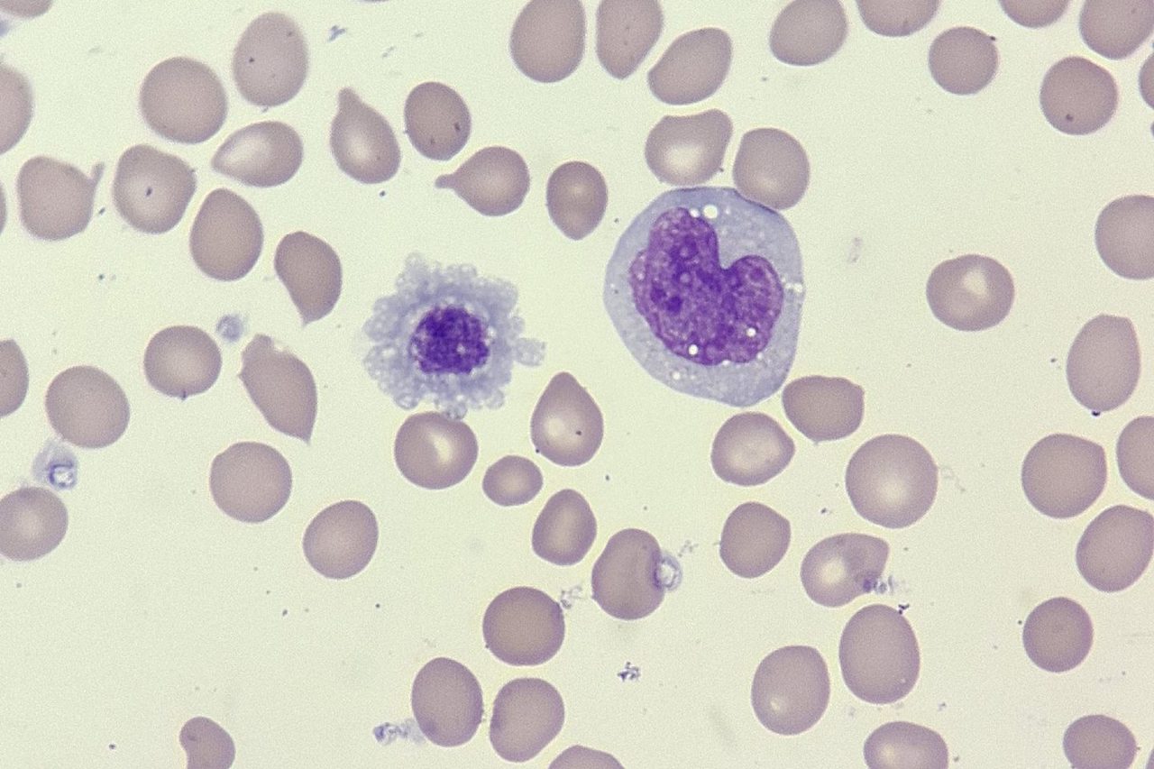 Monocyte and Giant Platelet in Peripheral Blood Smear