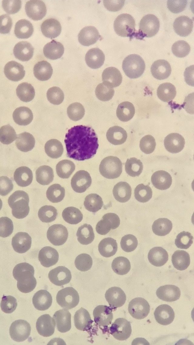 Basophil Morphology in Peripheral Blood Smear