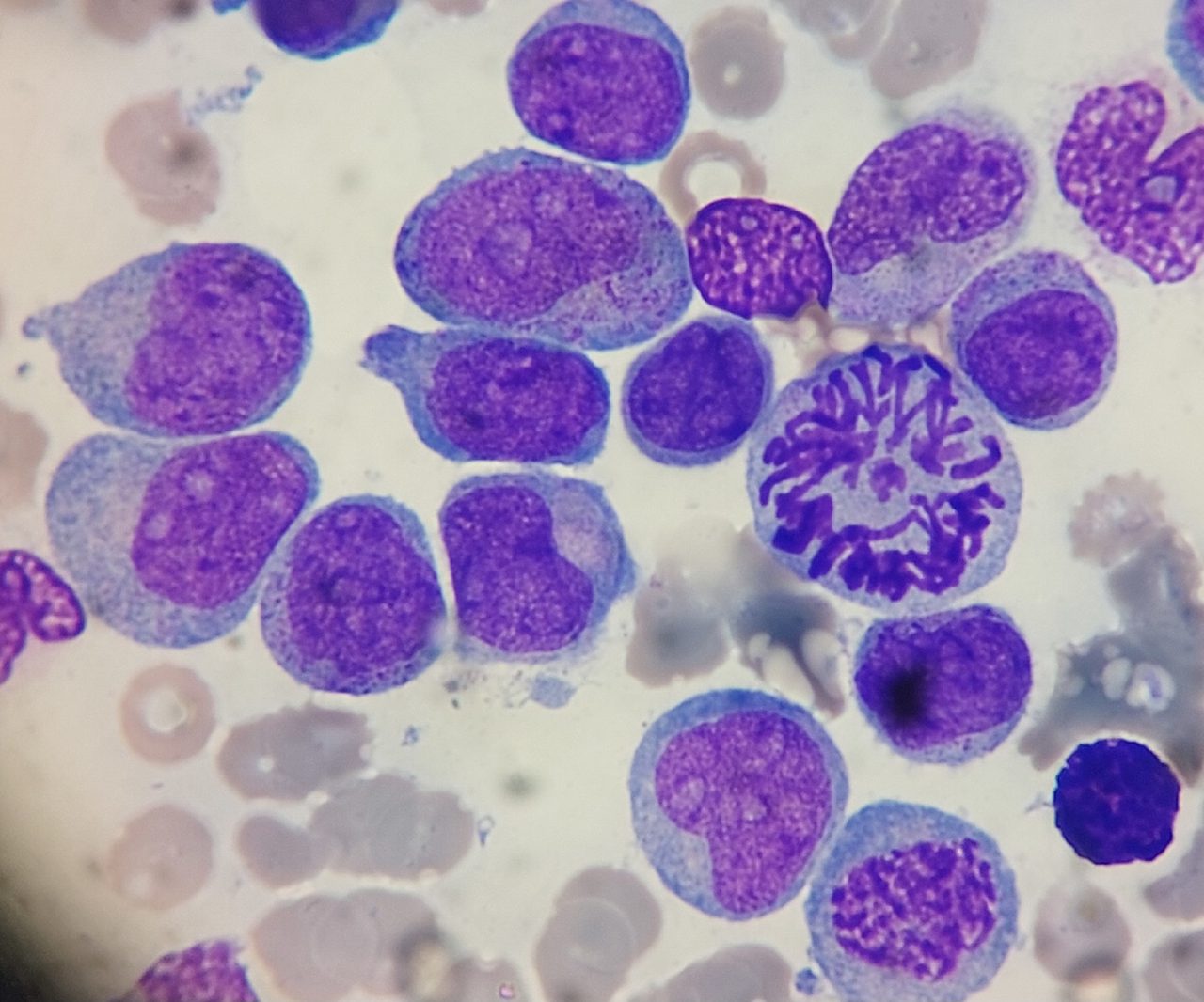 Blast Morphology and Mitotic Figures in Acute Leukemia
