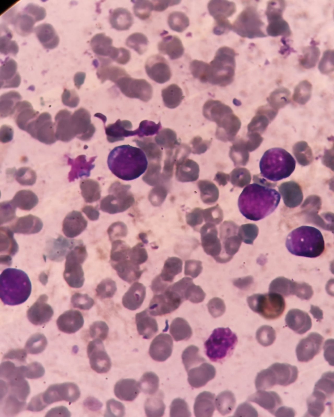 Morphology of Blasts in Acute Lymphoblastic Leukemia L3