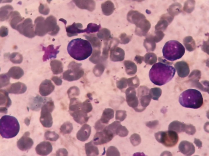 Bone marrow smear: medium-sized blast cells with round nuclei