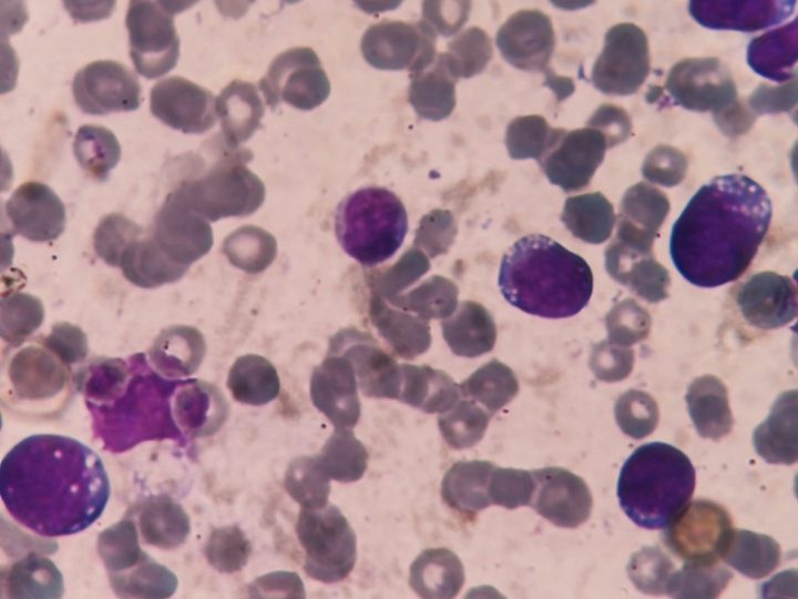 Bone marrow smear: blasts with basophilic vacuolated cytoplasm