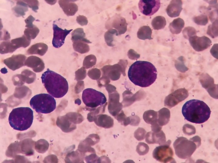 Bone marrow smear: displacement of normal hematopoiesis by L3-like blasts