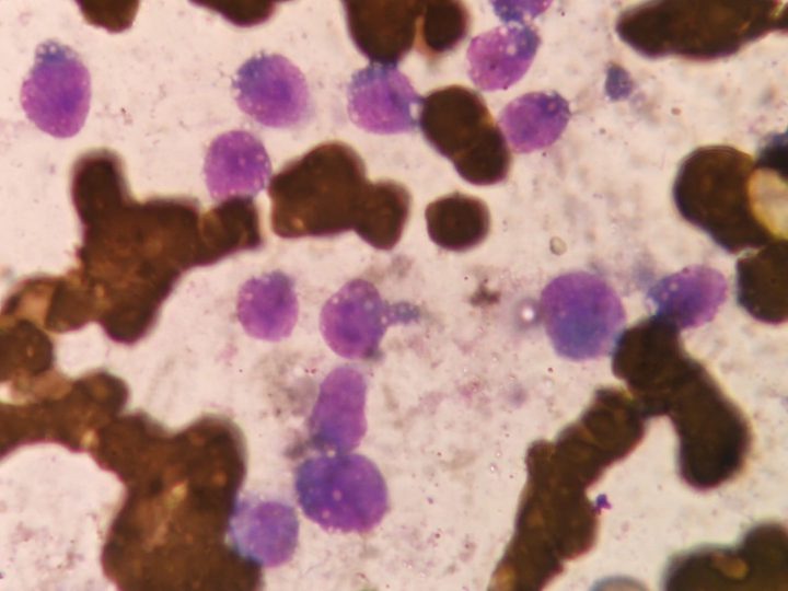 Bone marrow smear: a group of blast cells in the microscope field of view