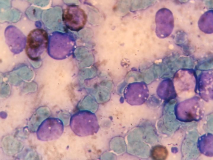 Bone marrow smear: morphology of blasts with distinct cytoplasmic vacuoles