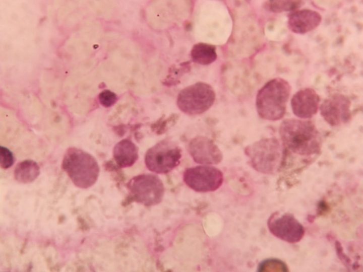 Cytochemical preparation: negative myeloperoxidase reaction in blasts