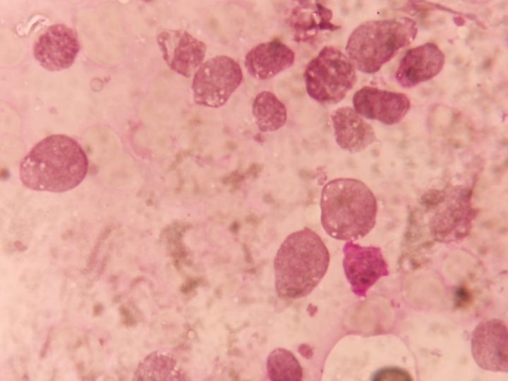 Cytochemical smear: absence of lipid accumulation in blast cytoplasm
