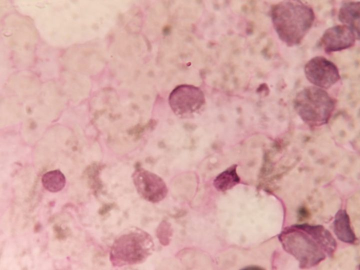 Cytochemical preparation: evaluation of PAS reaction in the blast cell population