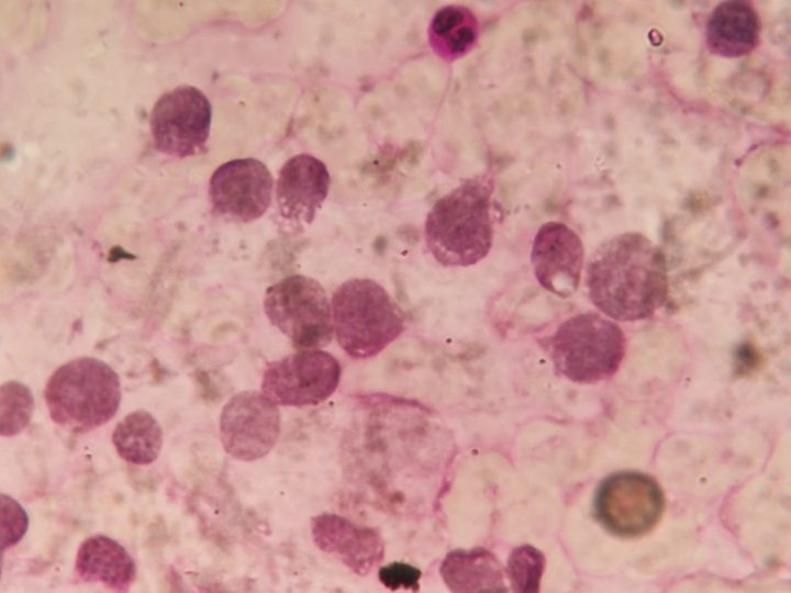 Bone marrow smear: weak granular PAS reaction in single blasts