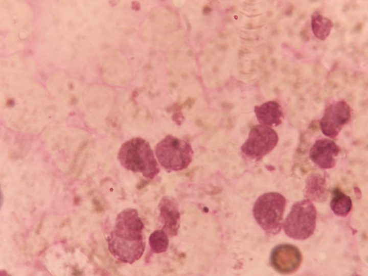 Cytochemical study: diffusely negative reaction for glycogen in blasts
