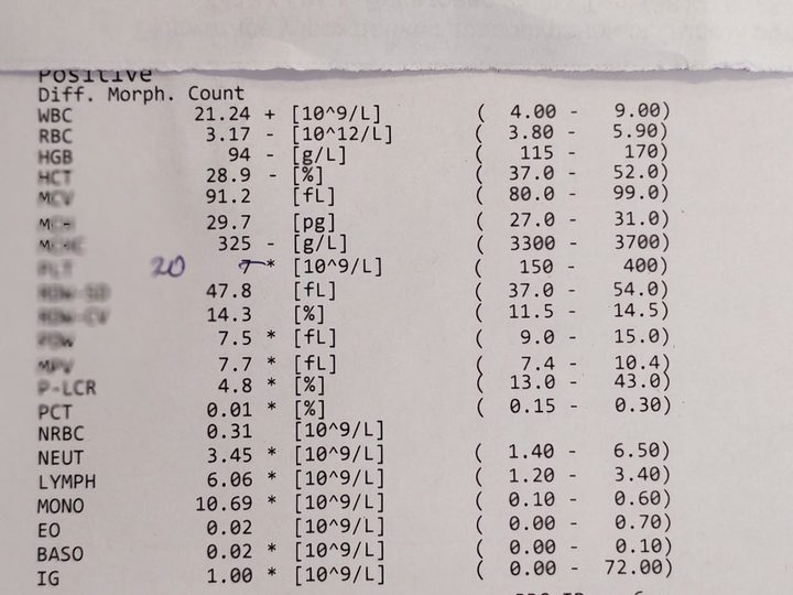 Распечатка анализатора: лейкоцитоз 21,24×10⁹/л, тромбоцитопения и анемия