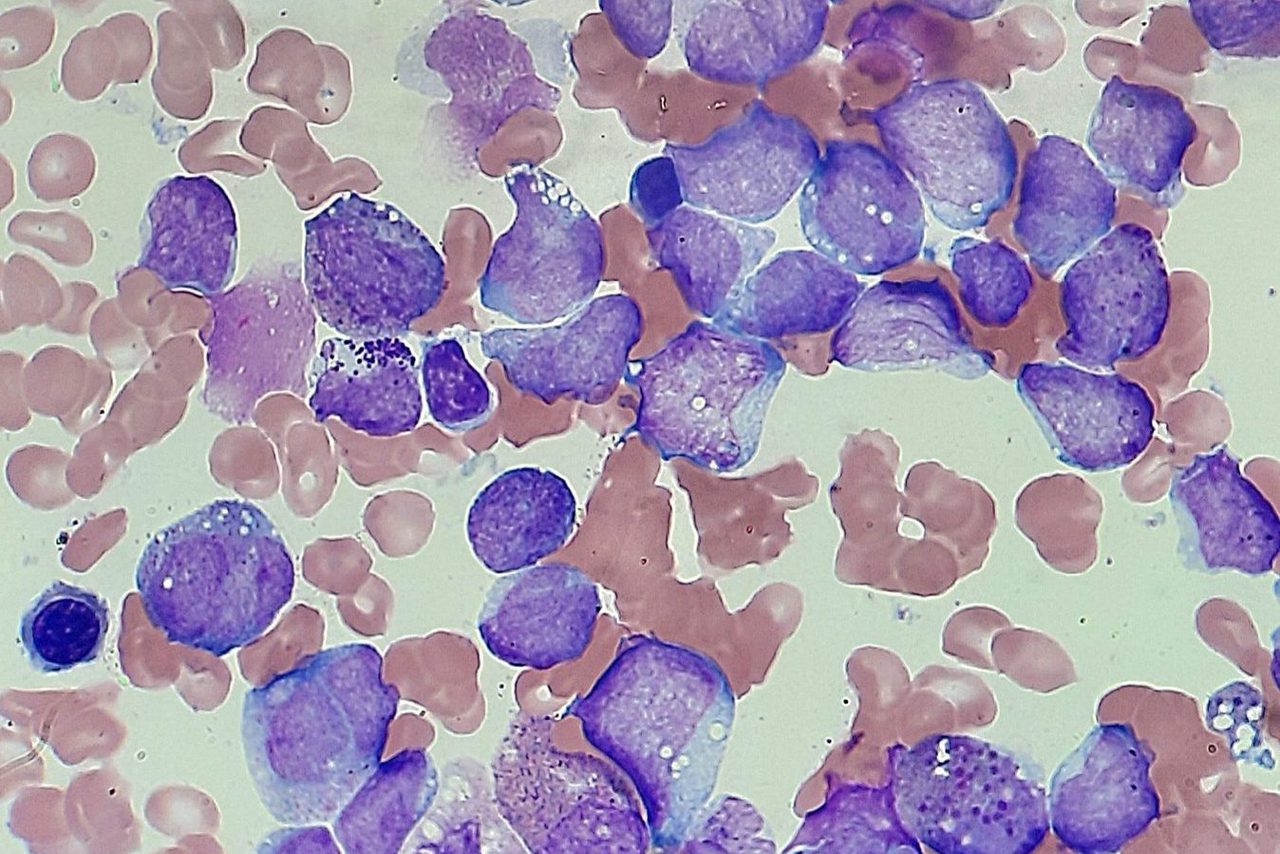 Blast Morphology in Bone Marrow in Pancytopenia