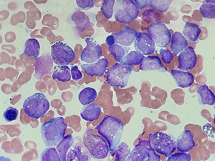 Bone marrow smear: cluster of blasts with distinct vacuoles in the cytoplasm