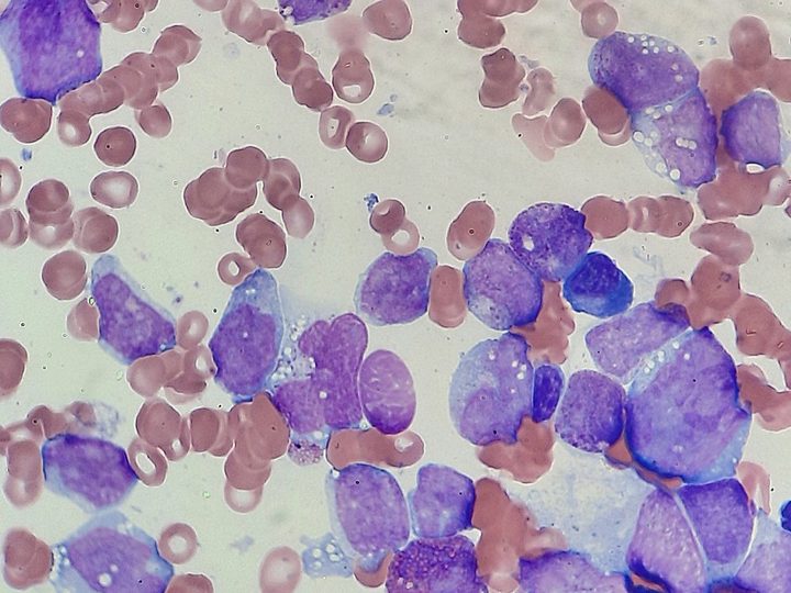 Bone marrow smear: blast cells with numerous small vacuoles