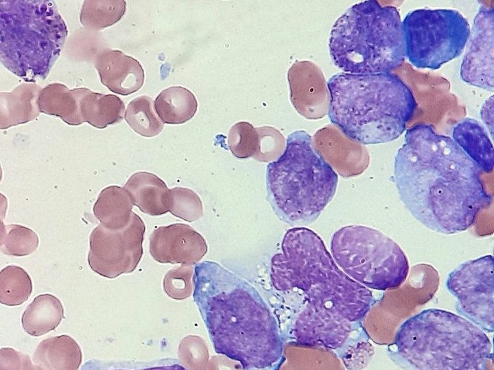 Bone marrow smear: blasts with basophilic cytoplasm and optically empty vacuoles
