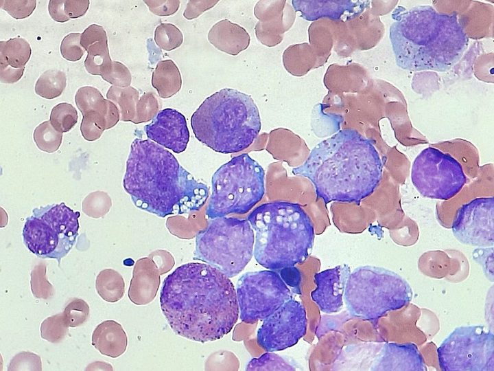 Bone marrow smear: atypical blasts with delicate chromatin and vacuolization