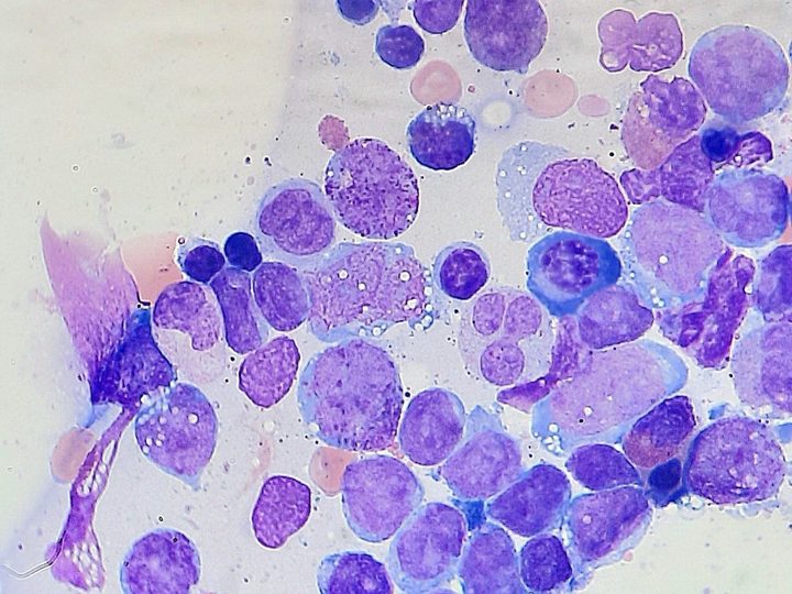 Bone marrow smear: field of view with a predominance of blast cells of different sizes