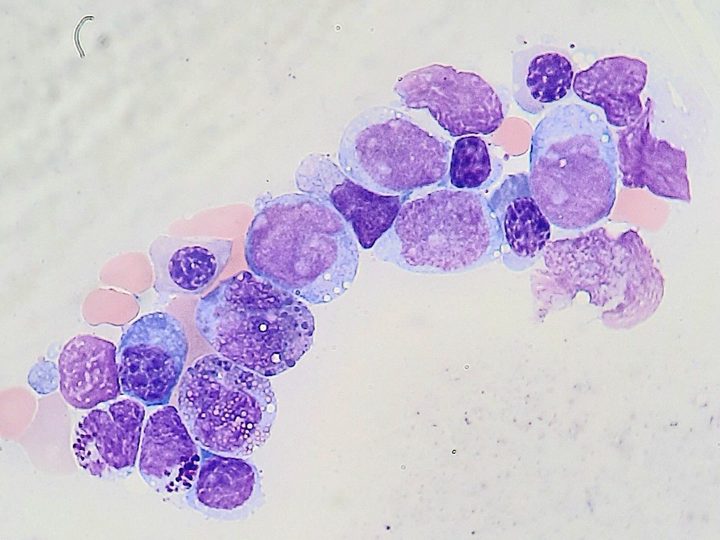 Bone marrow smear: group of vacuolated blasts in the aspirate