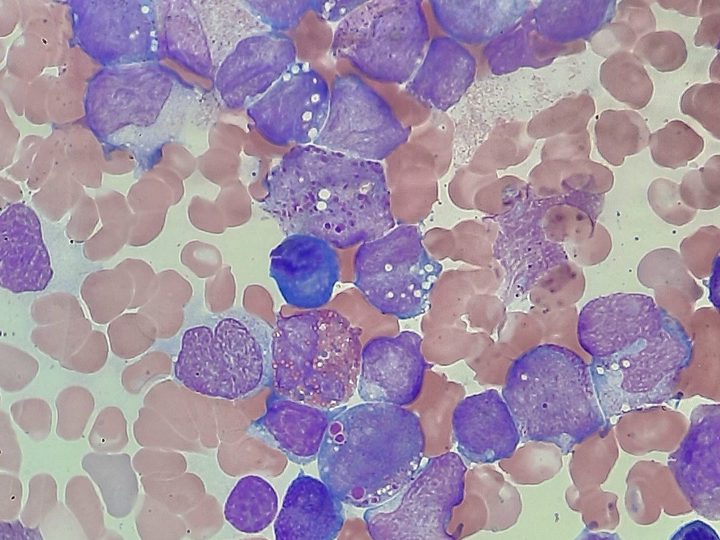 Bone marrow smear: blasts with pronounced granularity and cytoplasmic vacuoles