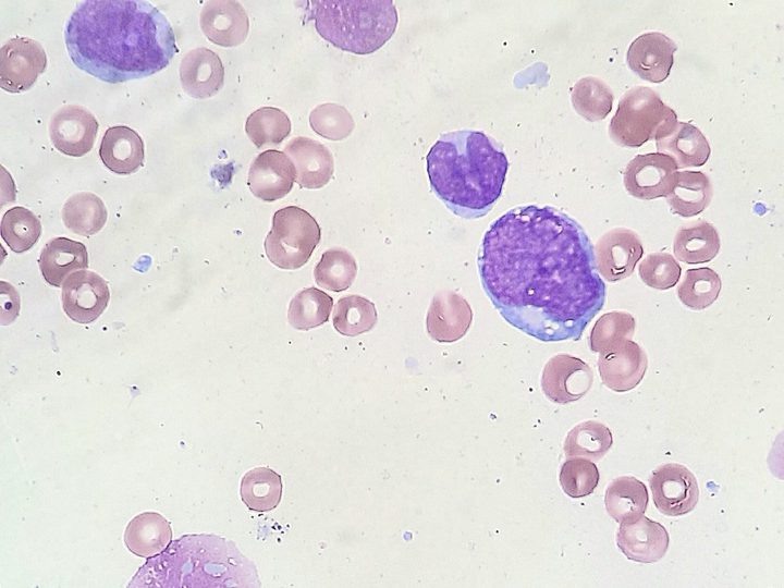 Bone marrow smear: blast cells and single mononuclears against a background of erythrocytes