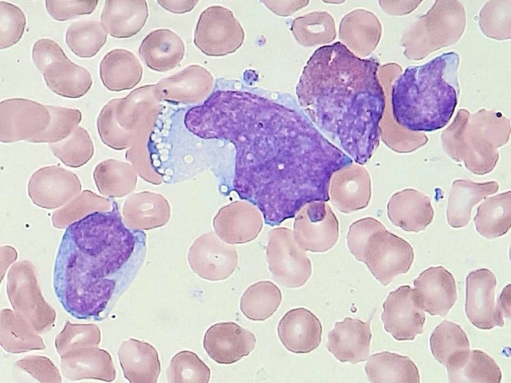 Bone marrow smear: large blast with a chain of small vacuoles along the edge of the cytoplasm