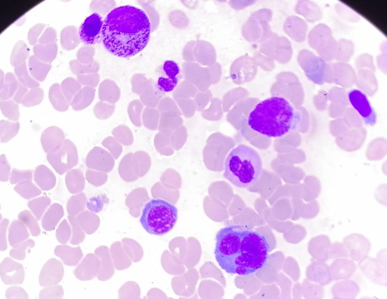 Bone Marrow Dyserythropoiesis Morphology in MDS