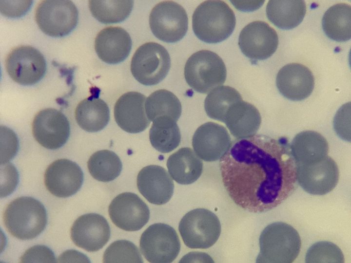 Blood smear, eosinophil with a bean-shaped nucleus and fine cytoplasmic granulation