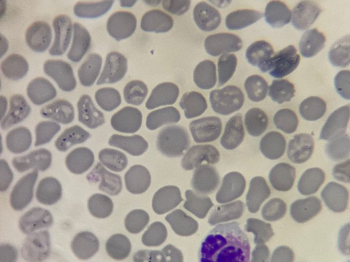 Blood smear, eosinophil with a lobed nucleus against a background of erythrocyte anisocytosis