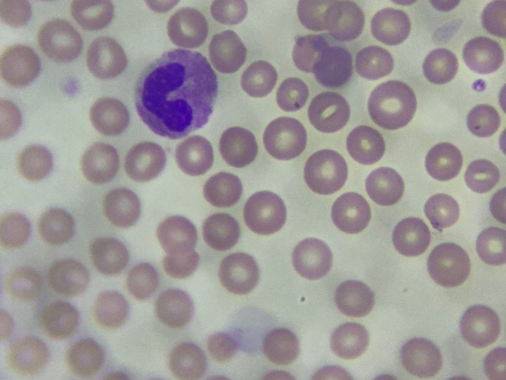 Blood smear, eosinophil with a bilobed nucleus and oxyphilic granulation