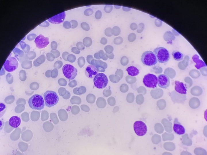 Bone marrow smear: normoblasts of various maturity stages and granulocytes
