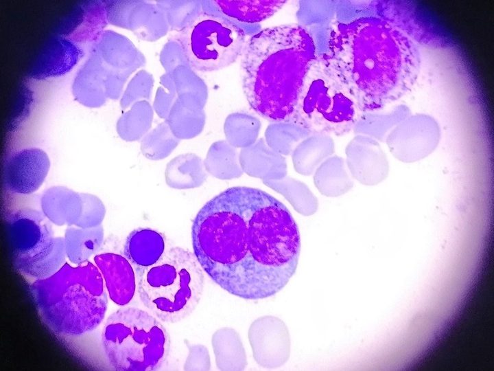 Bone marrow smear: binucleated erythrocaryocyte in the center of the field of view