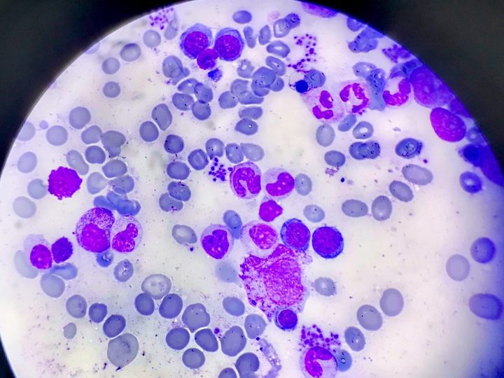 Bone marrow smear: active erythropoiesis and maturing granulocytic series cells