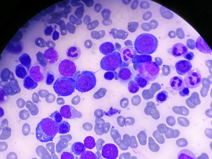 Bone marrow smear: closely located proliferating erythrocaryocytes
