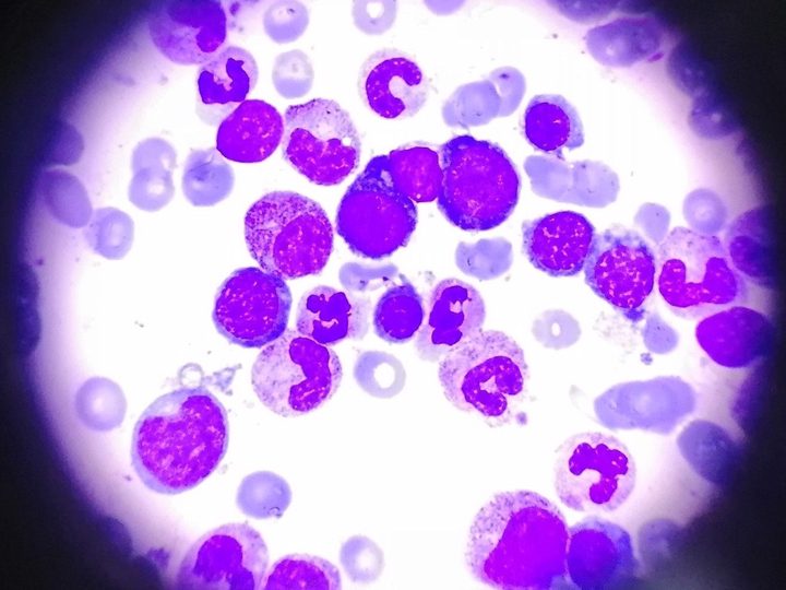 Bone marrow smear: erythropoietic focus with erythroid cells and granulocytes