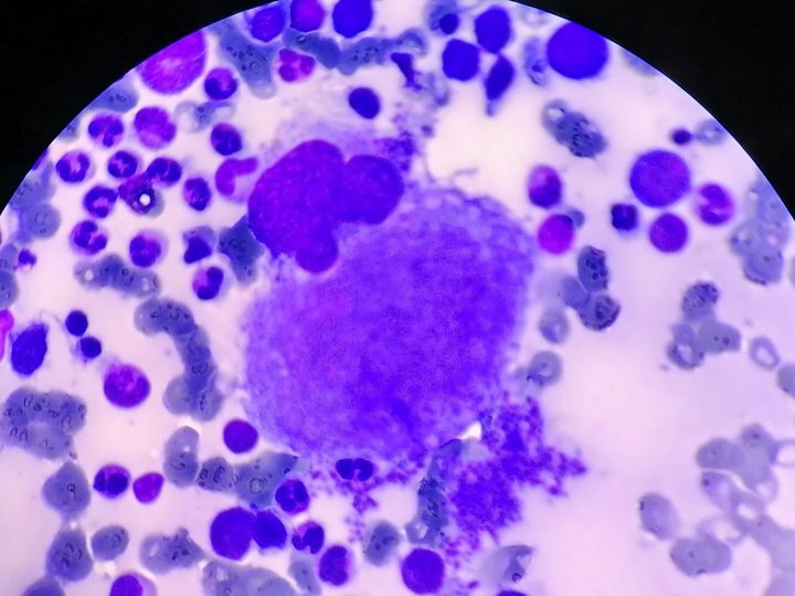 Bone marrow smear: mature megakaryocyte in the process of platelet budding