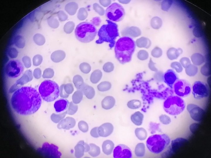 Bone marrow smear: atypical complex structure, probable artifact